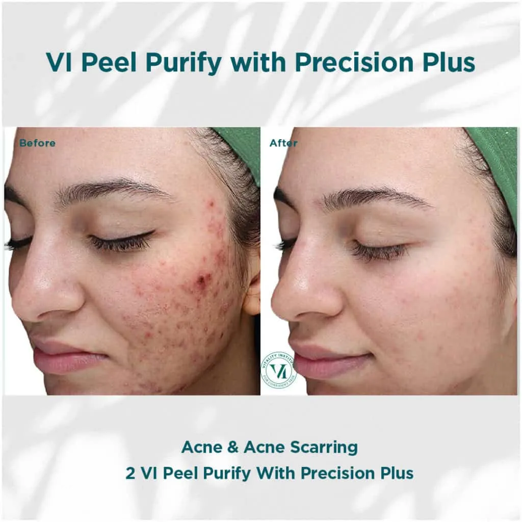 VI Peels Before and After image