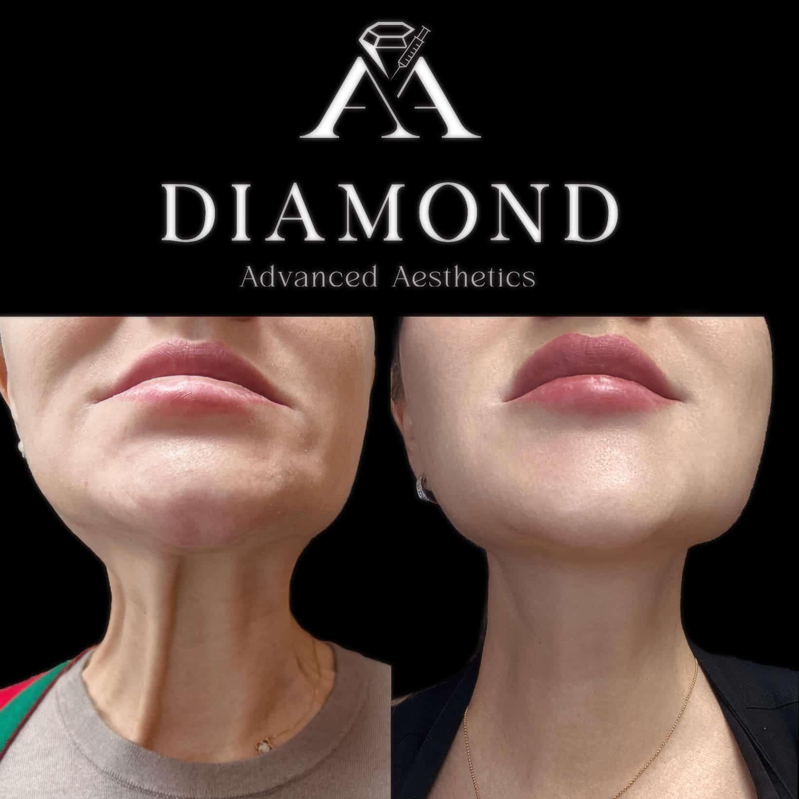 neuromodulators - Diamond advanceed aesthetic