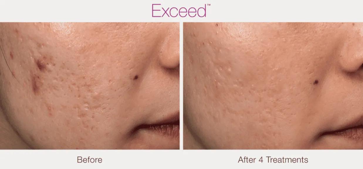 Exceed-microneedling-After-&-Before-Img-by-Diamond-Advanced-Aesthetics-in-New-York-NY