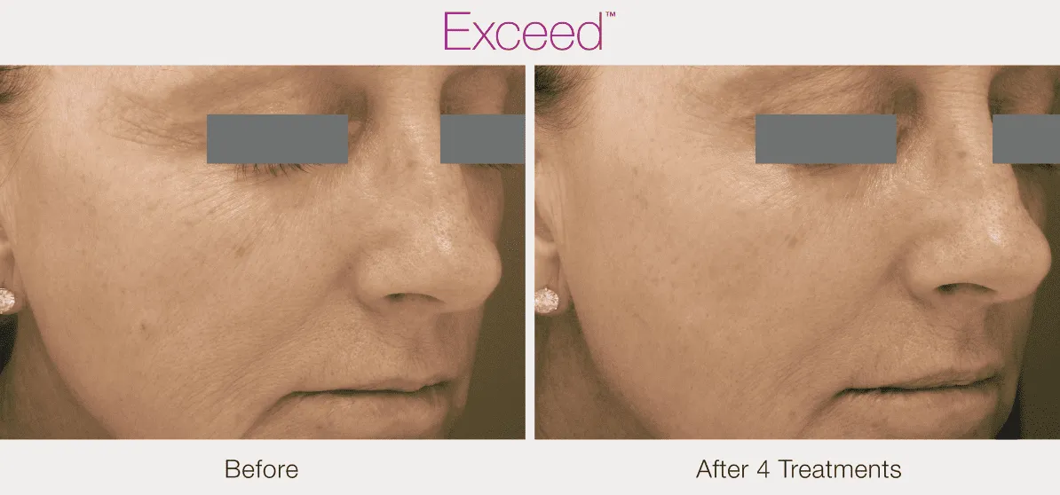 Exceed-microneedling-Before-and-After-Img-by-Diamond-Advanced-Aesthetics-in-New-York-NY
