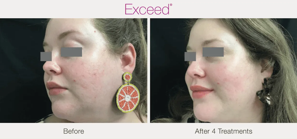 Exceed-microneedling-Before-and-After-by-Diamond-Advanced-Aesthetics-in-New-York-NY