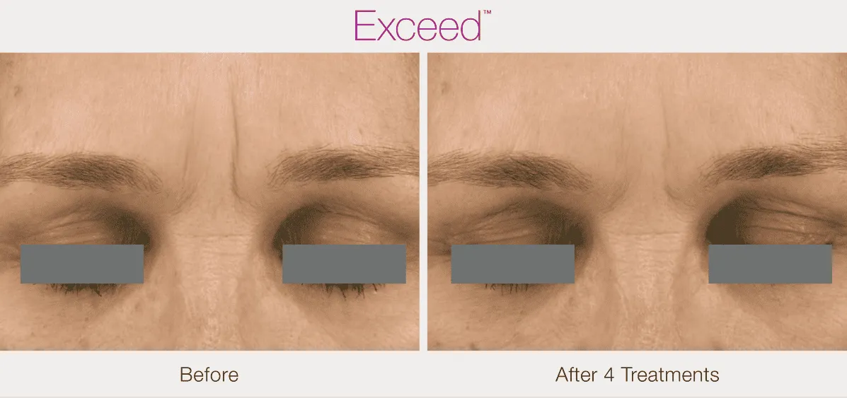 Exceed-microneedling-before-after-Before-&-After-by-Diamond-Advanced-Aesthetics-in-New-York-NY