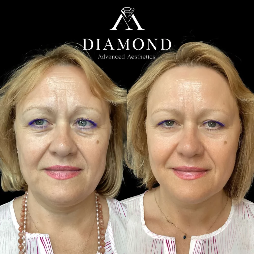 Hydrafacial Before-and-After |diamond advanced aesthetics | New york