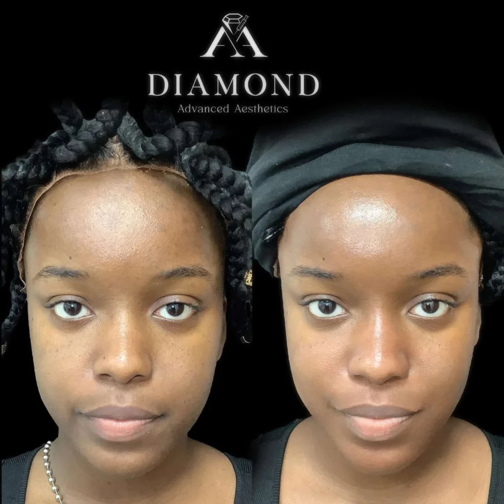 Hydrafacial Before-and-After |diamond advanced aesthetics | New york