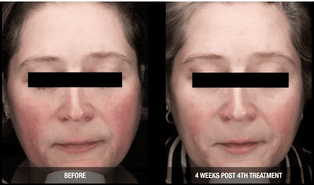 Nordlys-LightBright-Before-and-After |diamond advanced aesthetics | New york