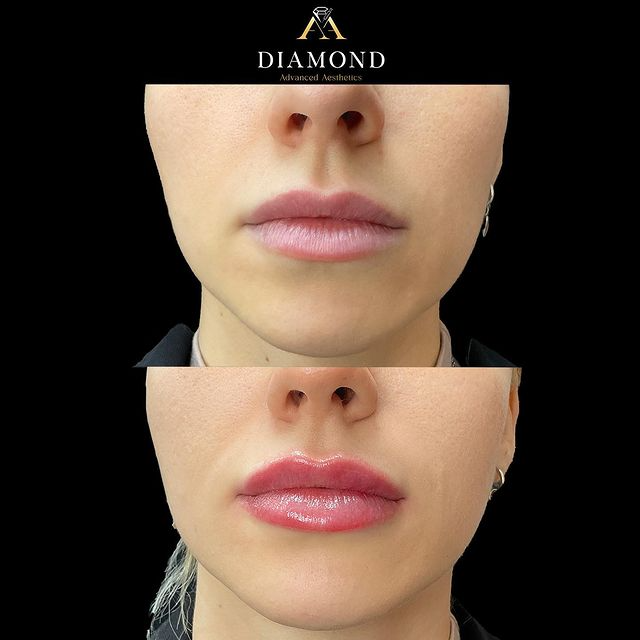before-after img |diamond advanced aesthetics | New york