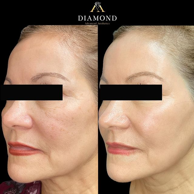 Before-after-img-nine-by-Diamond-Advanced-Aesthetics-in-New-York-NY