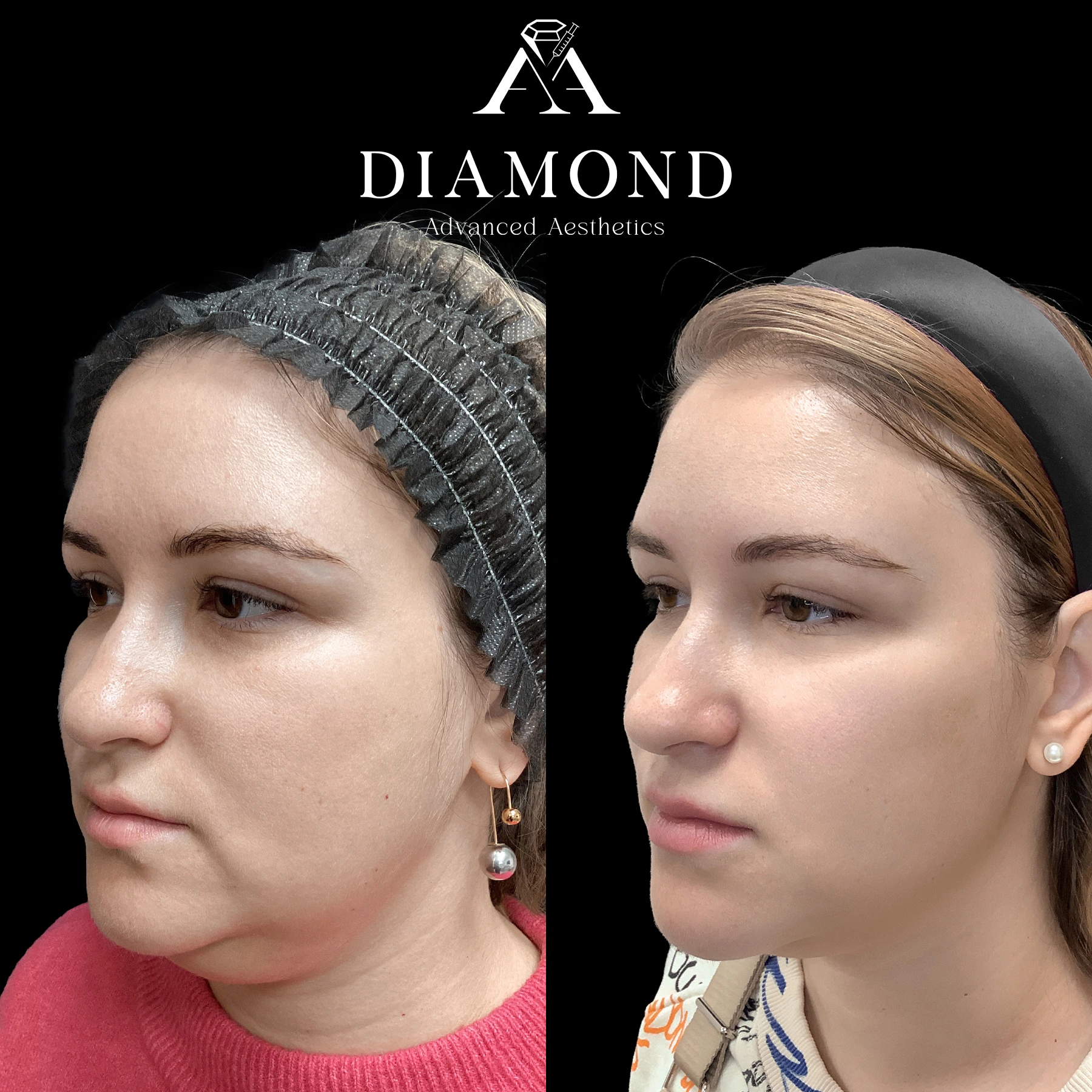 Before and After |diamond advanced aesthetics | New york|