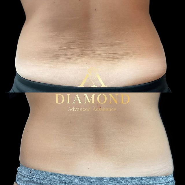 Before-after-img-sixteen-by-Diamond-Advanced-Aesthetics-in-New-York-NY