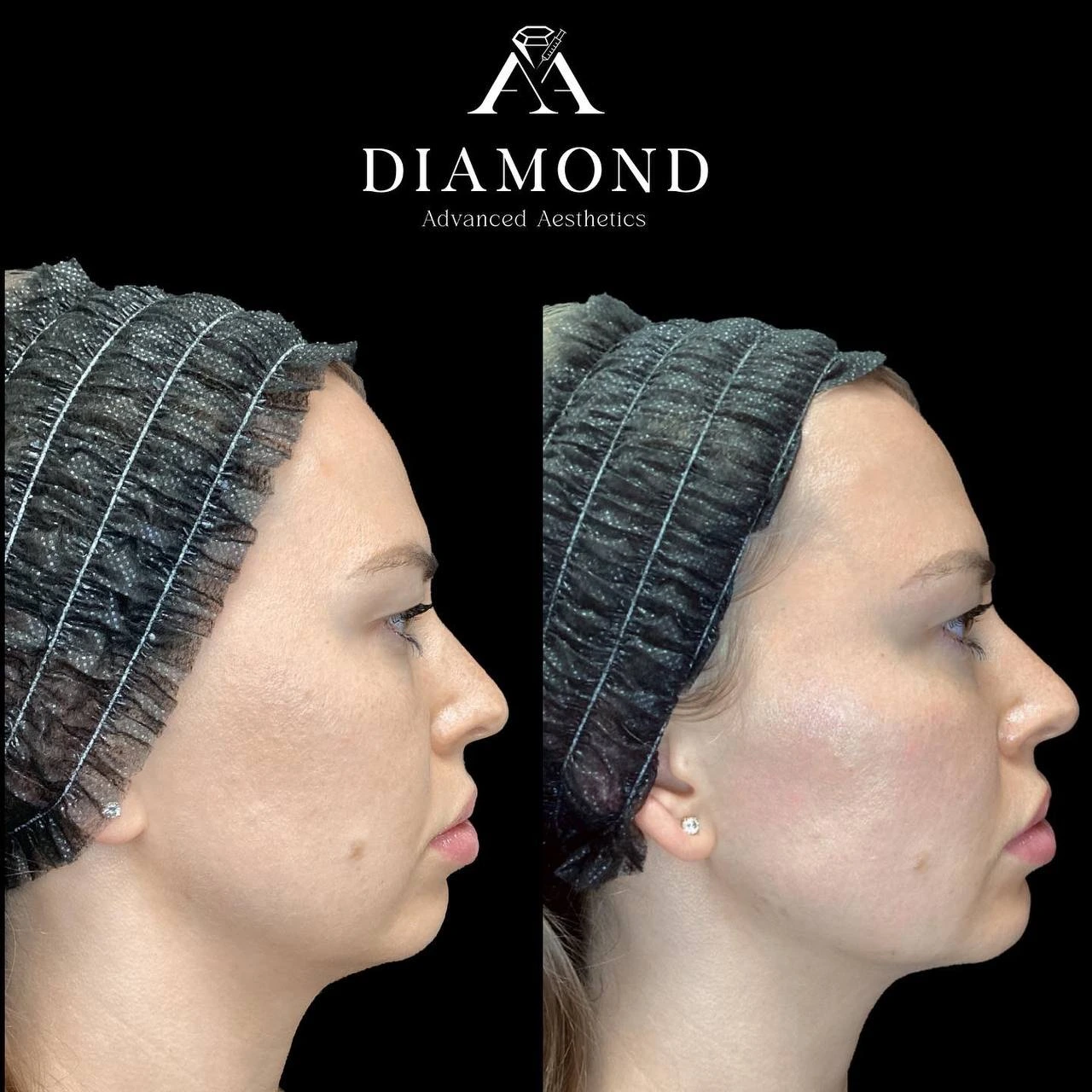 Before and After |diamond advanced aesthetics | New york |