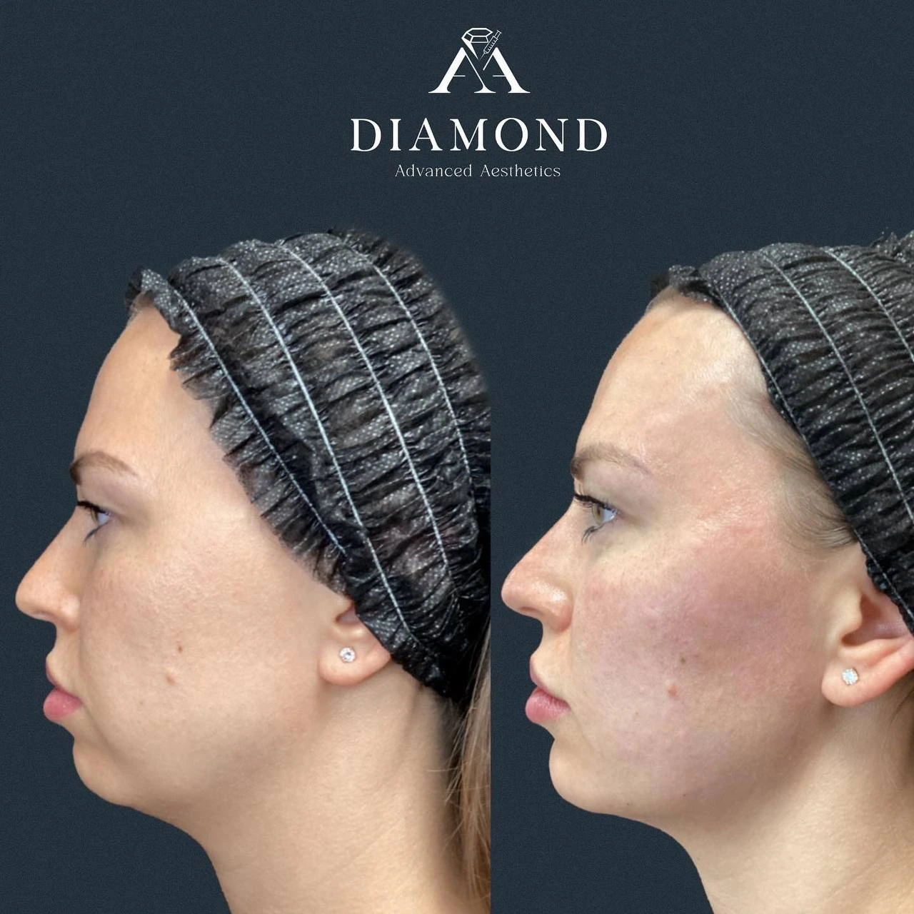 Before and After |diamond advanced aesthetics | New york |