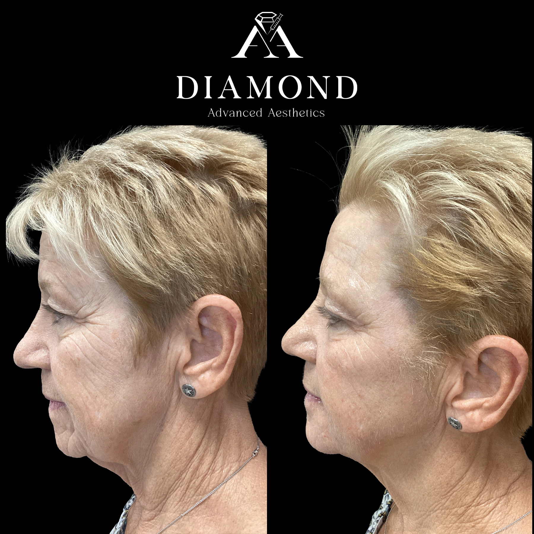 Before and After |diamond advanced aesthetics | New york|