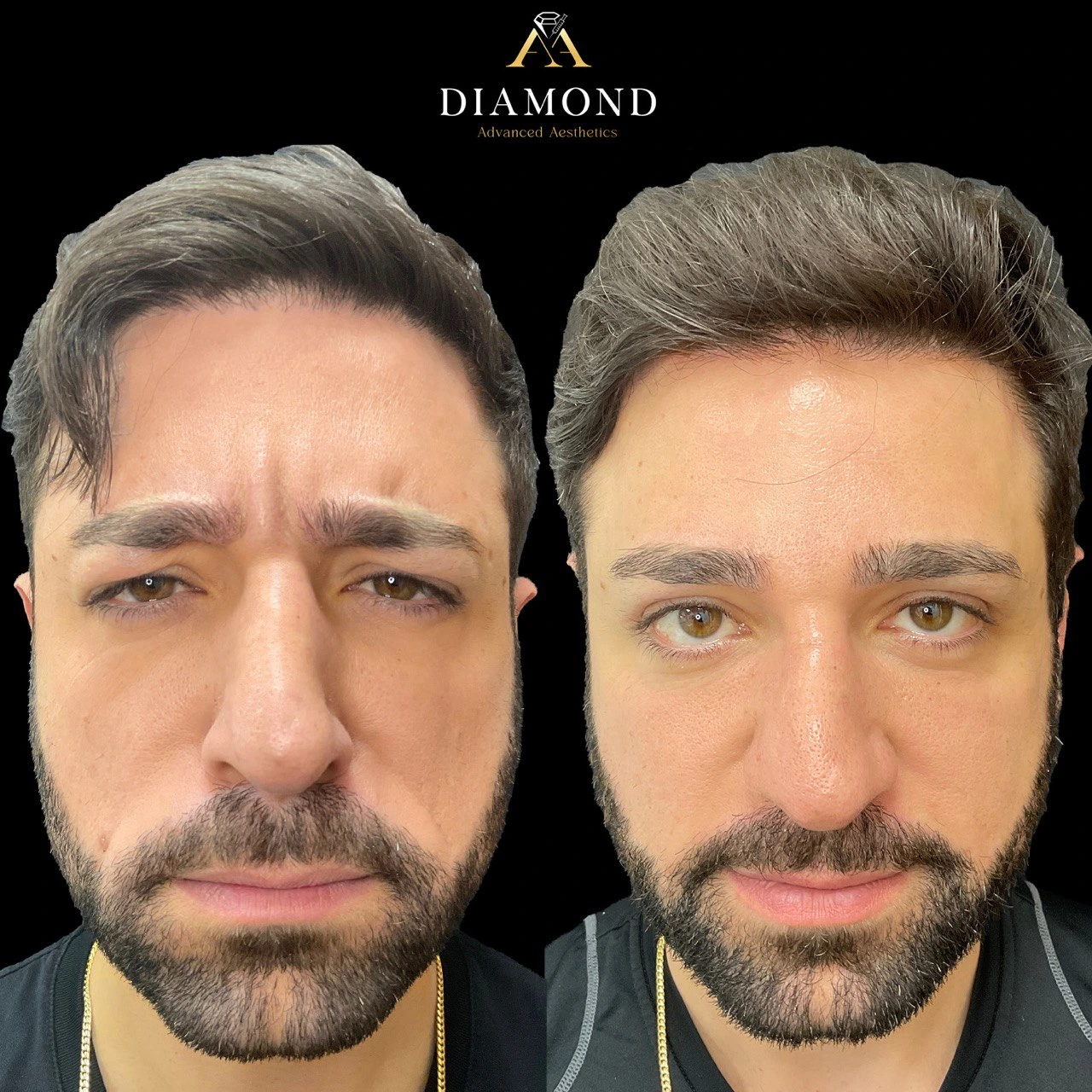 Face-AB-Img-by-Diamond-Advanced-Aesthetics-in-New-York-NY