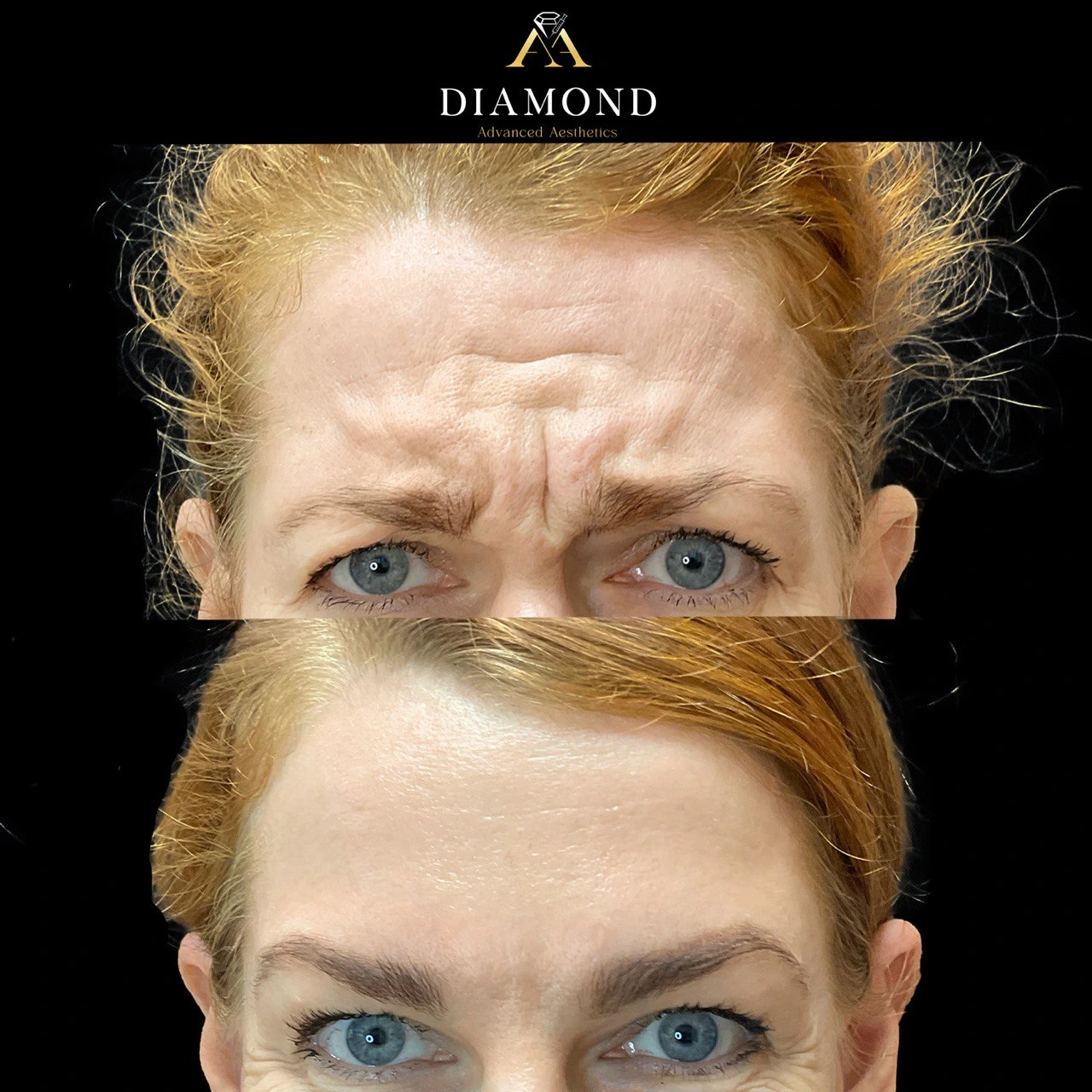 Forehead-After-before |diamond advanced aesthetics | New york|