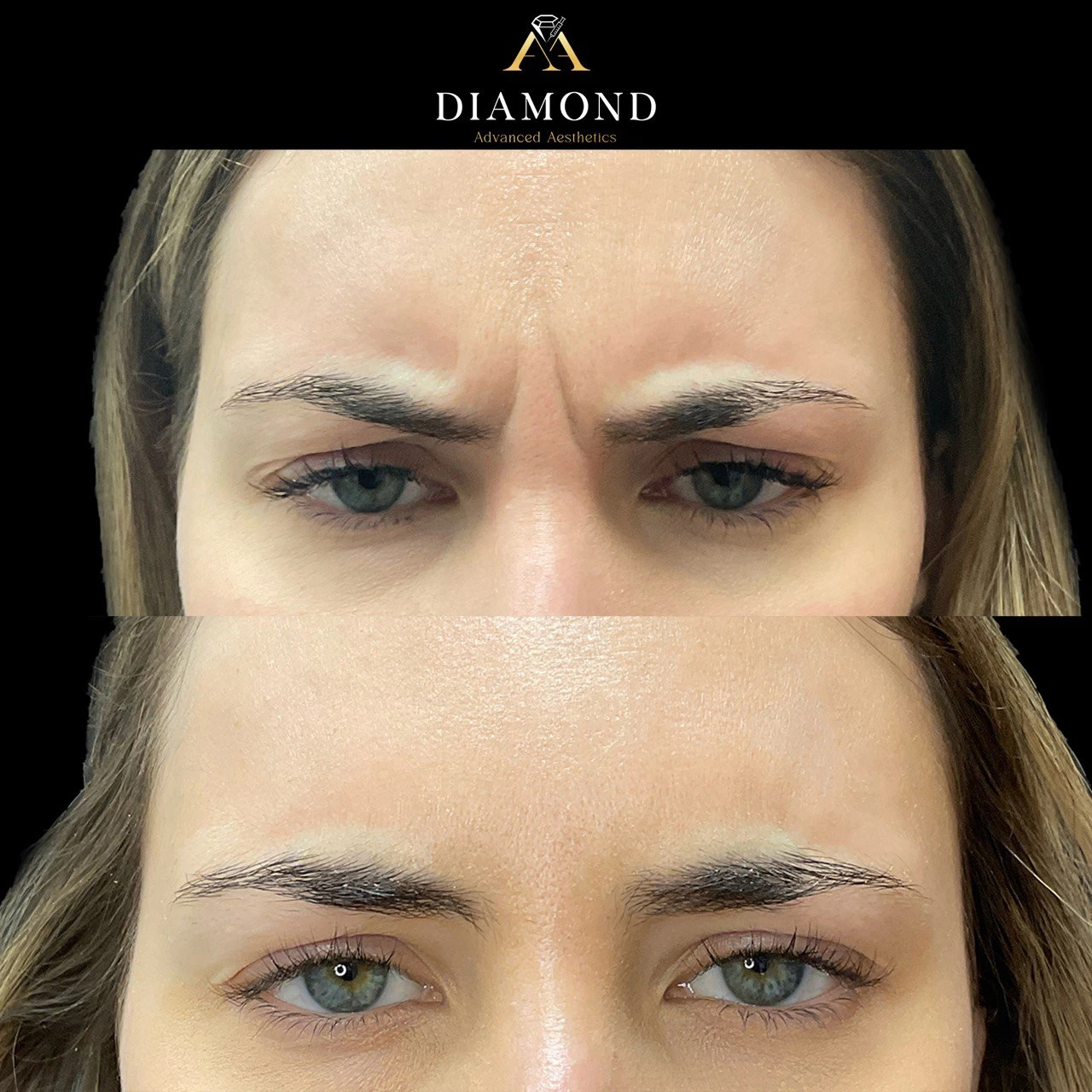 Forhead -After-before |diamond advanced aesthetics | New york|