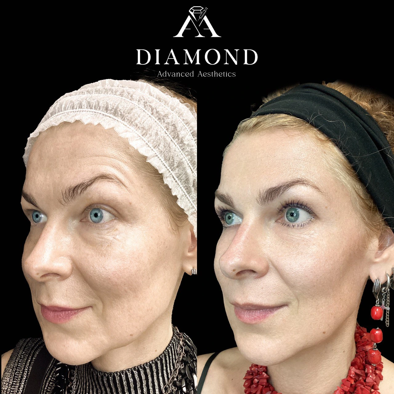 Morpheus |diamond advanced aesthetics | New york|