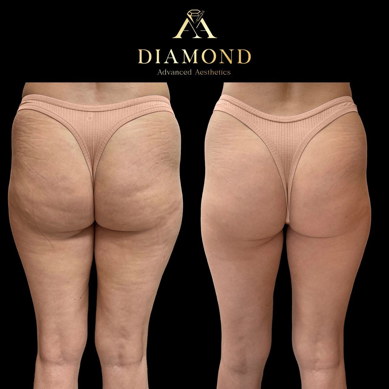 Morpheus8 New York, NY | Diamond Advanced Aesthetics