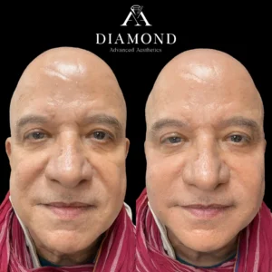 Bellafill by Diamond Advanced Aesthetics in New York NY