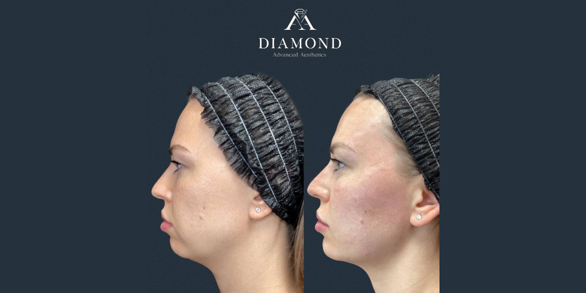 Bellafill by Diamond Advanced Aesthetics in New York NY