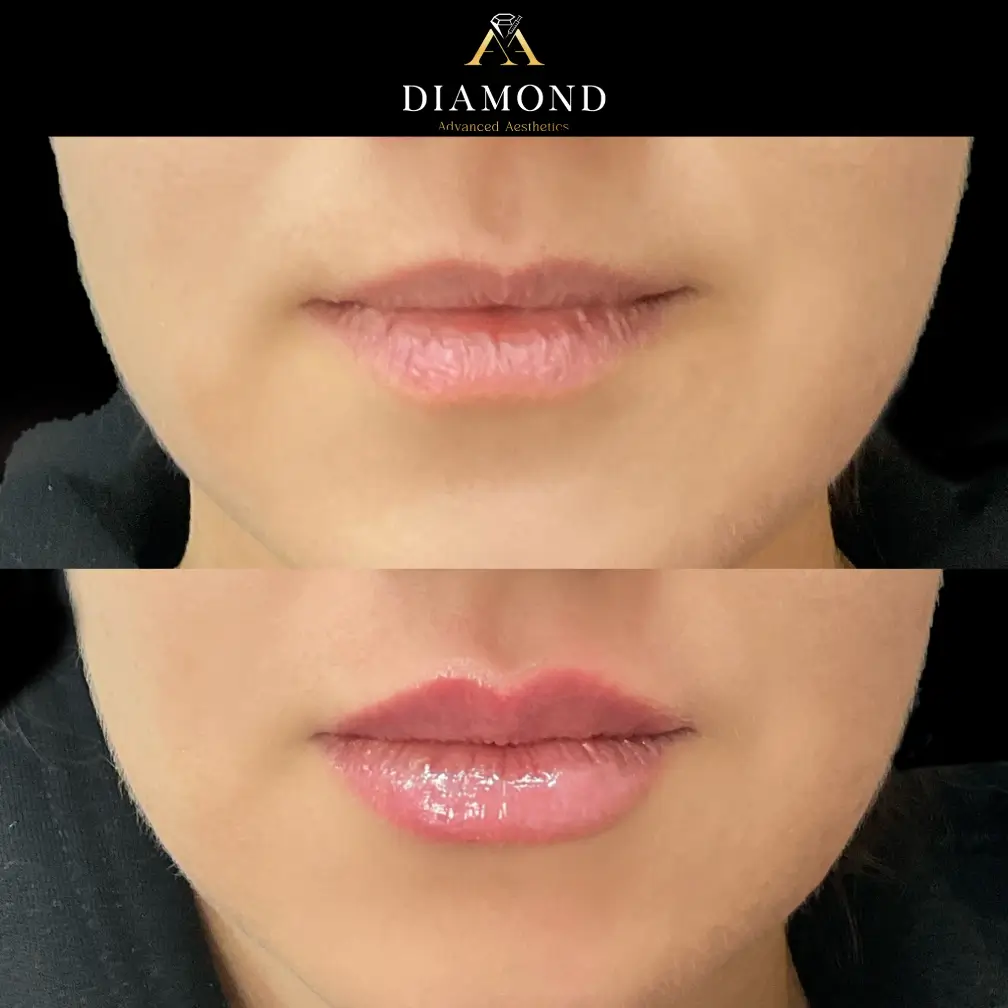 Lip augmentation |diamond advanced aesthetics | New york|