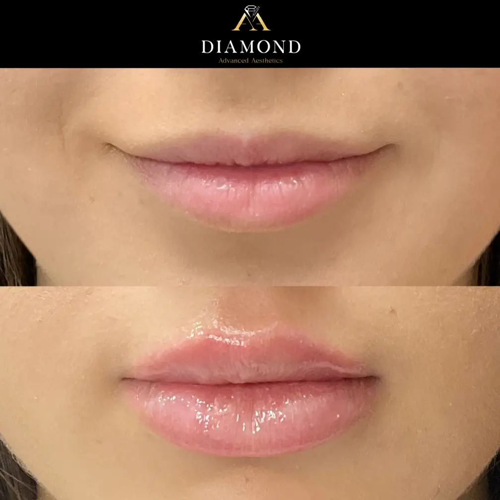 Lip augmentation |diamond advanced aesthetics | New york|