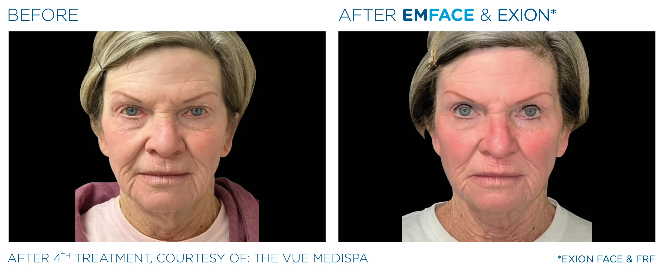 Emface Before & After 1
