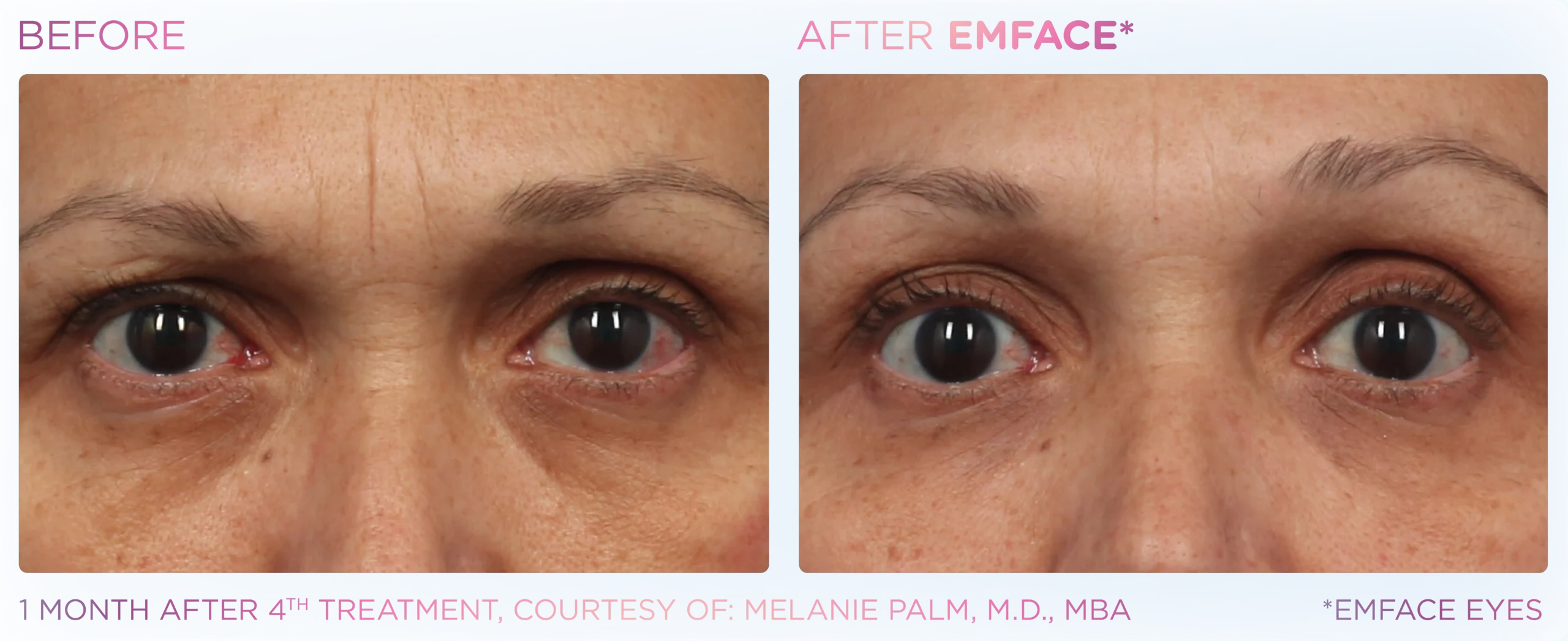 Emface Before & After 10