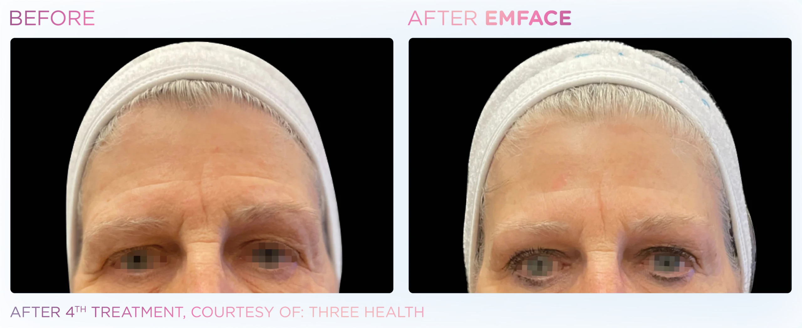 Emface Before & After 11
