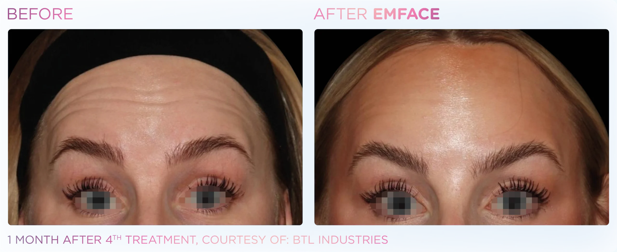 Emface Before & After 12