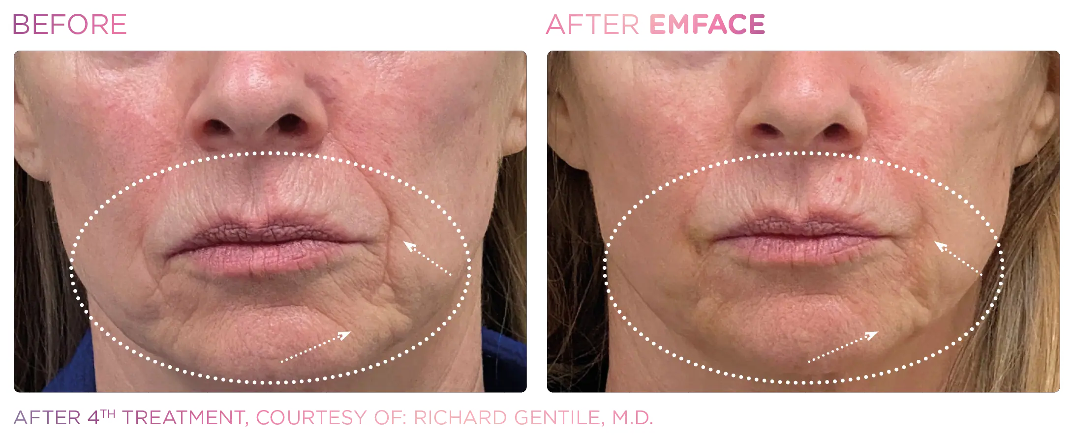 Emface Before & After 13