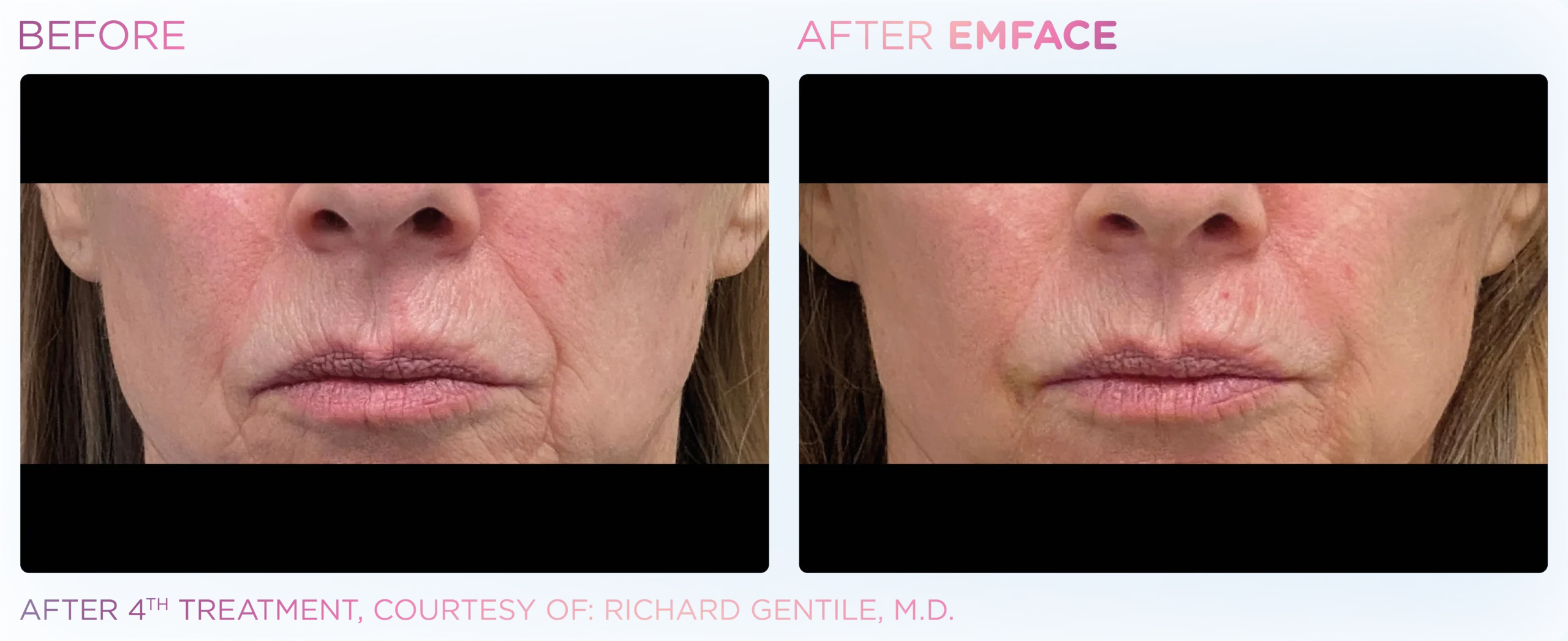 Emface Before & After 14