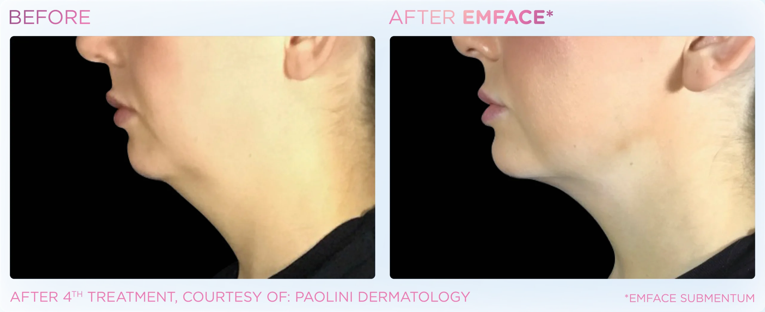 Emface Before & After 15