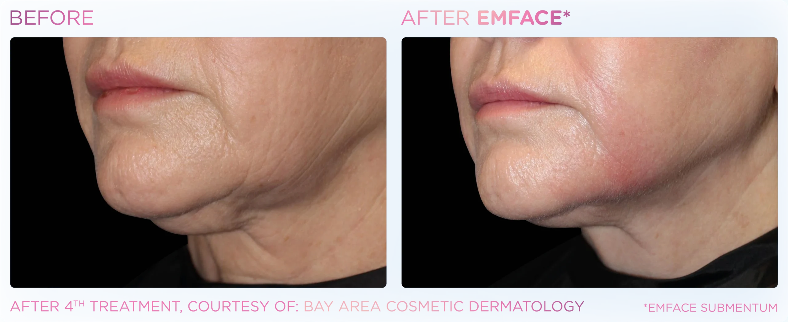 Emface Before & After 16