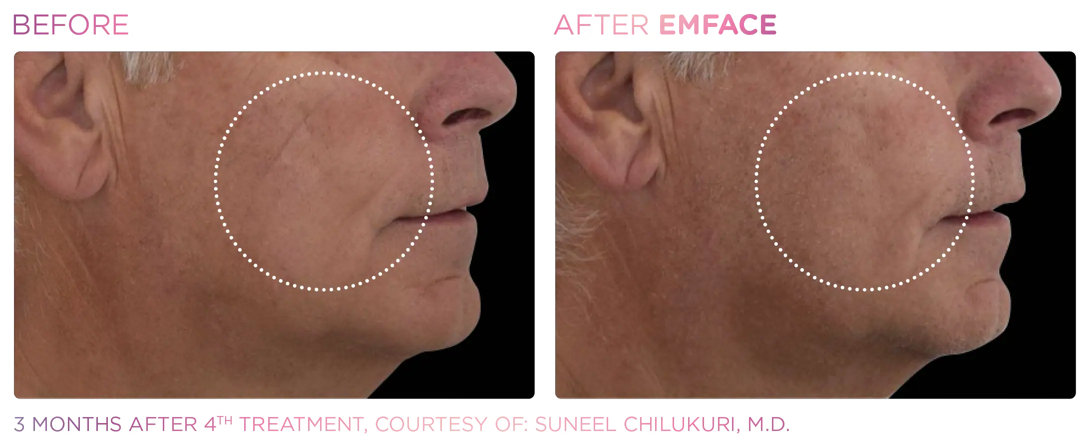 Emface Before & After 17