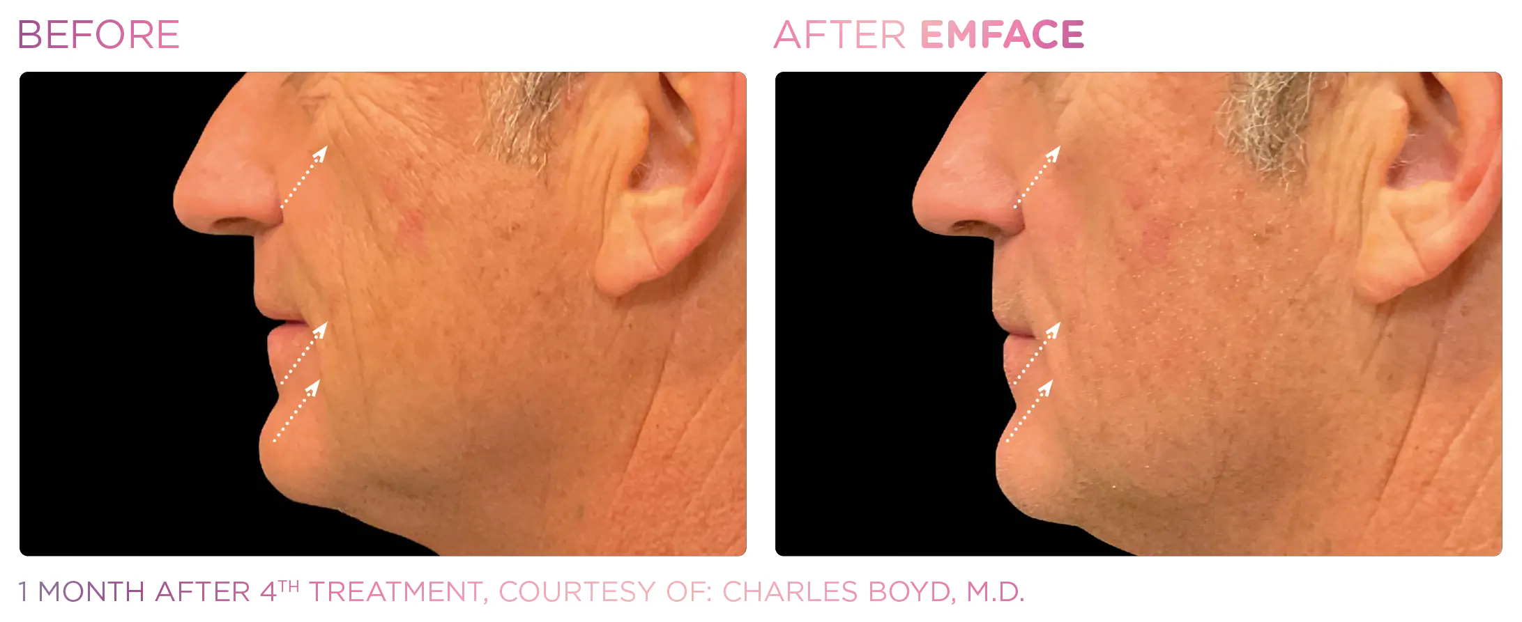 Emface Before & After 18