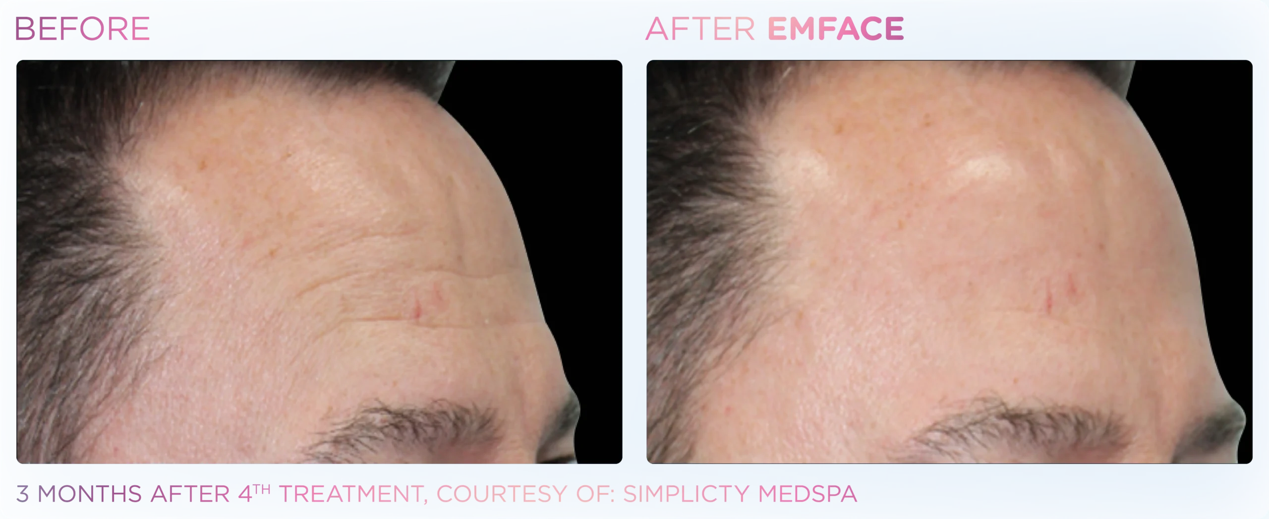 Emface Before & After 19