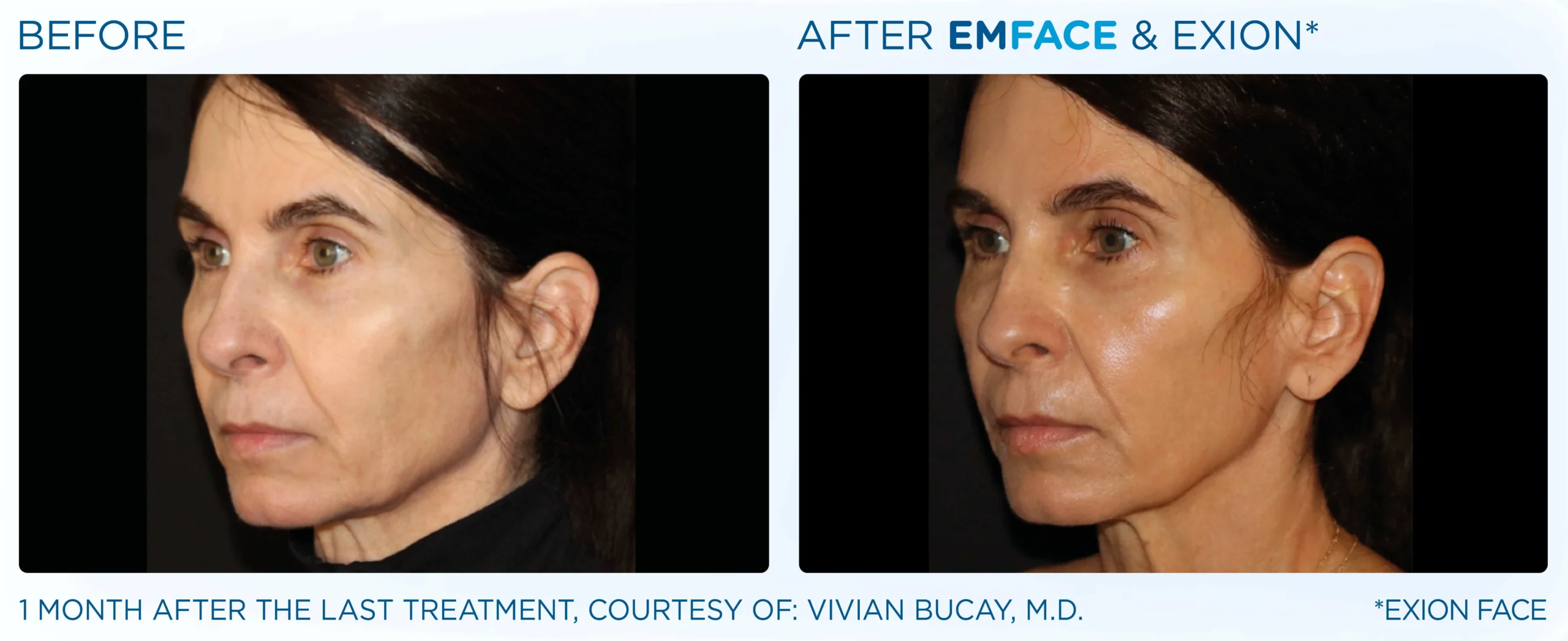 Emface Before & After 2
