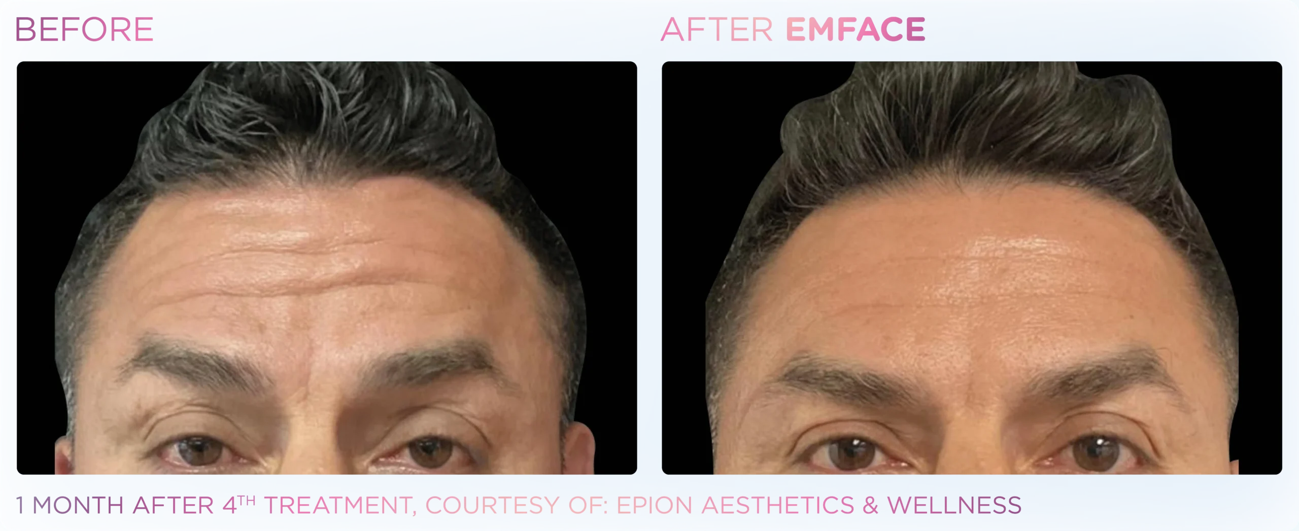 Emface Before & After 20