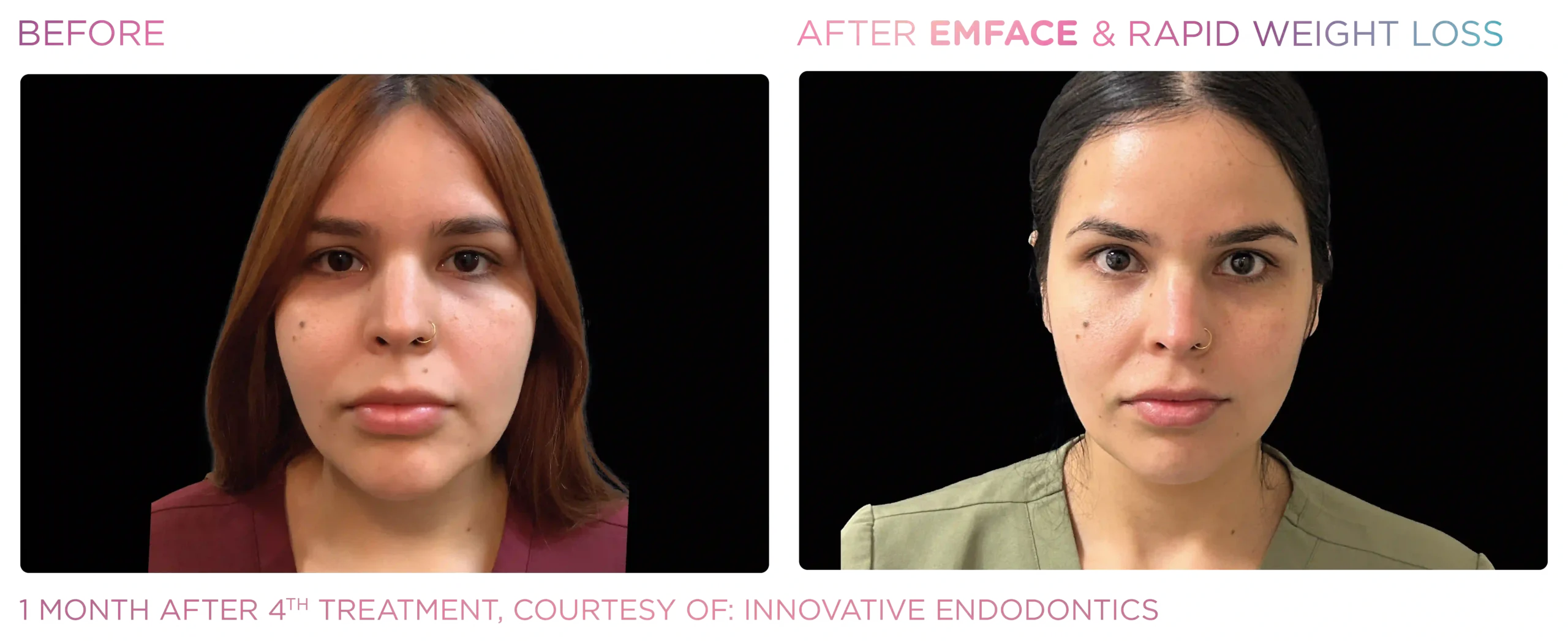 Emface Before & After 21