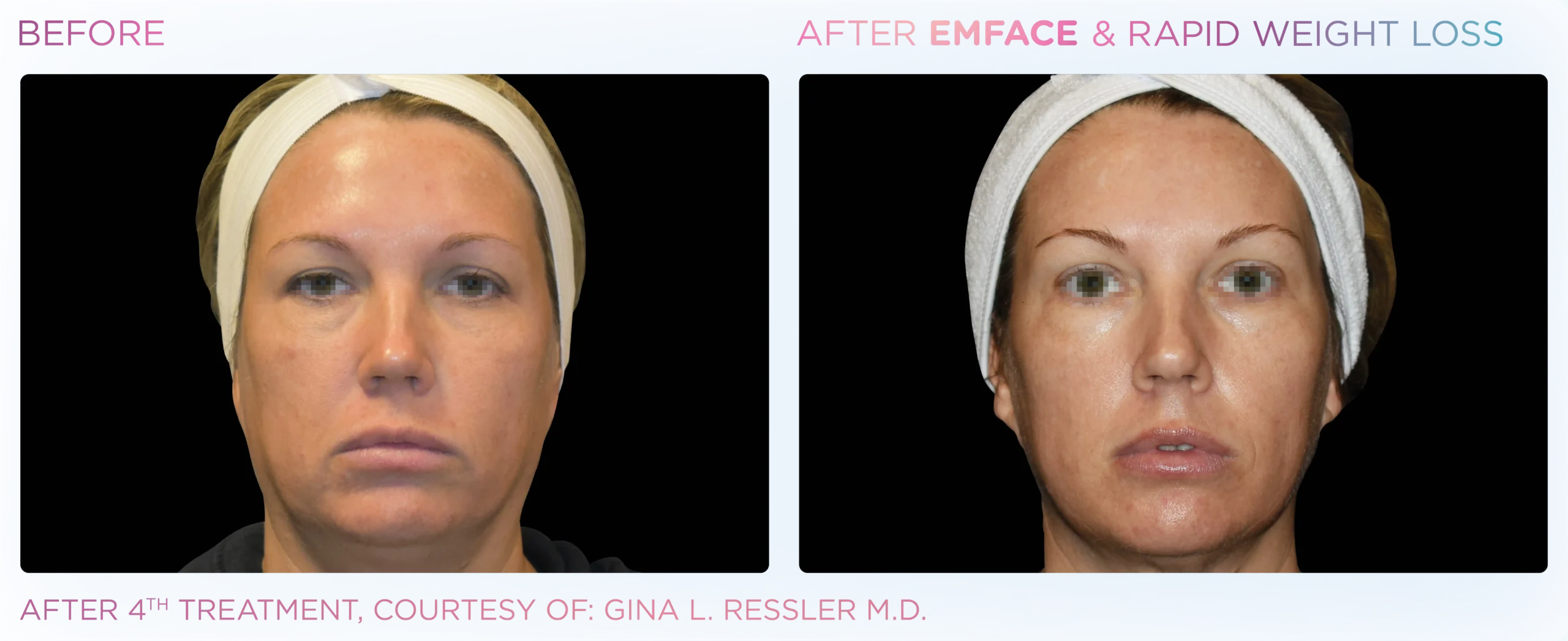 Emface Before & After 22