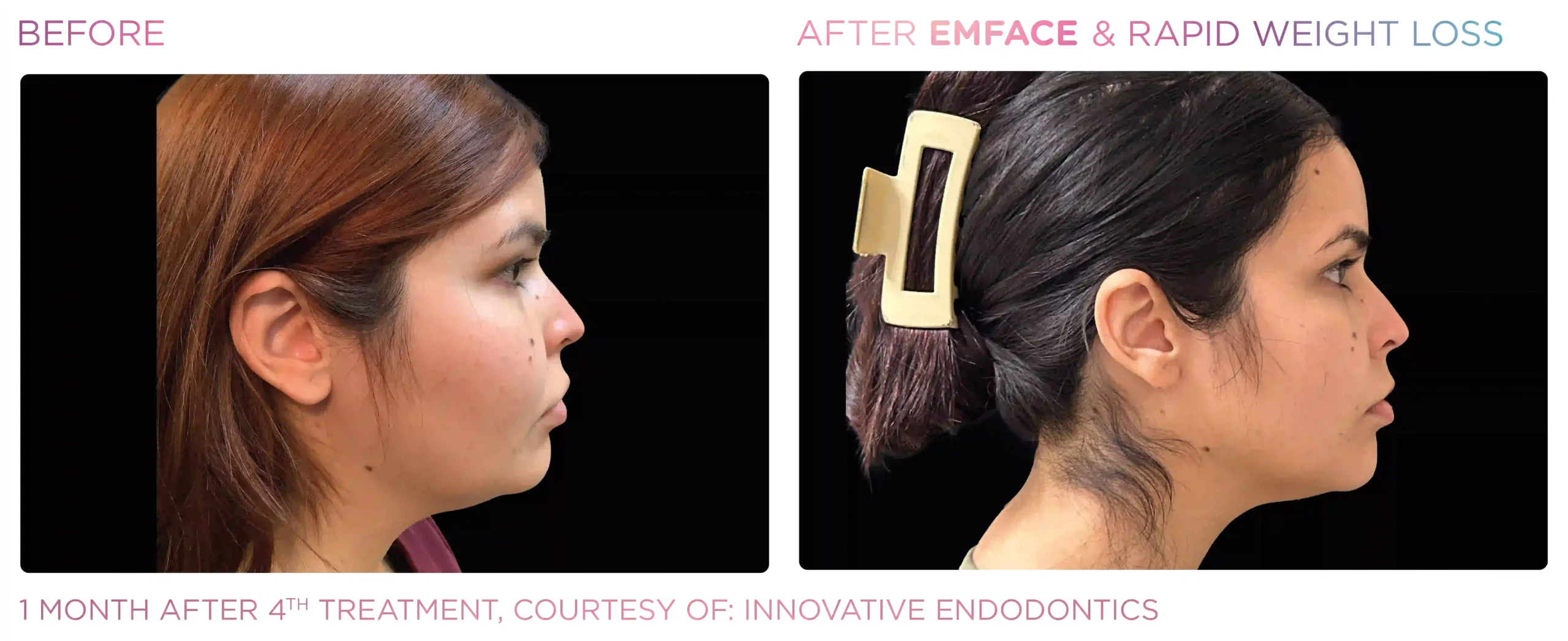 Emface Before & After 23
