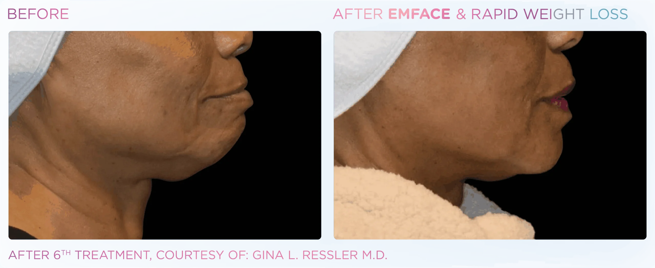 Emface Before & After 24