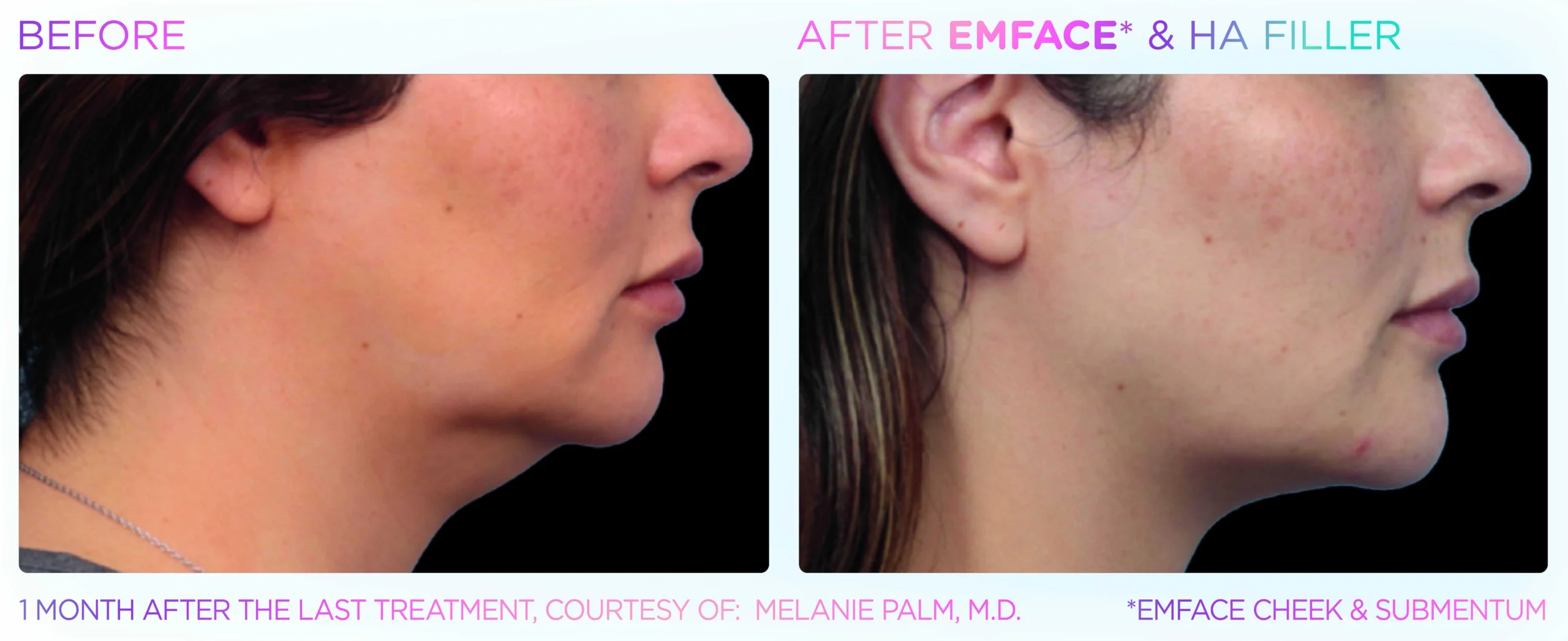 Emface Before & After 3