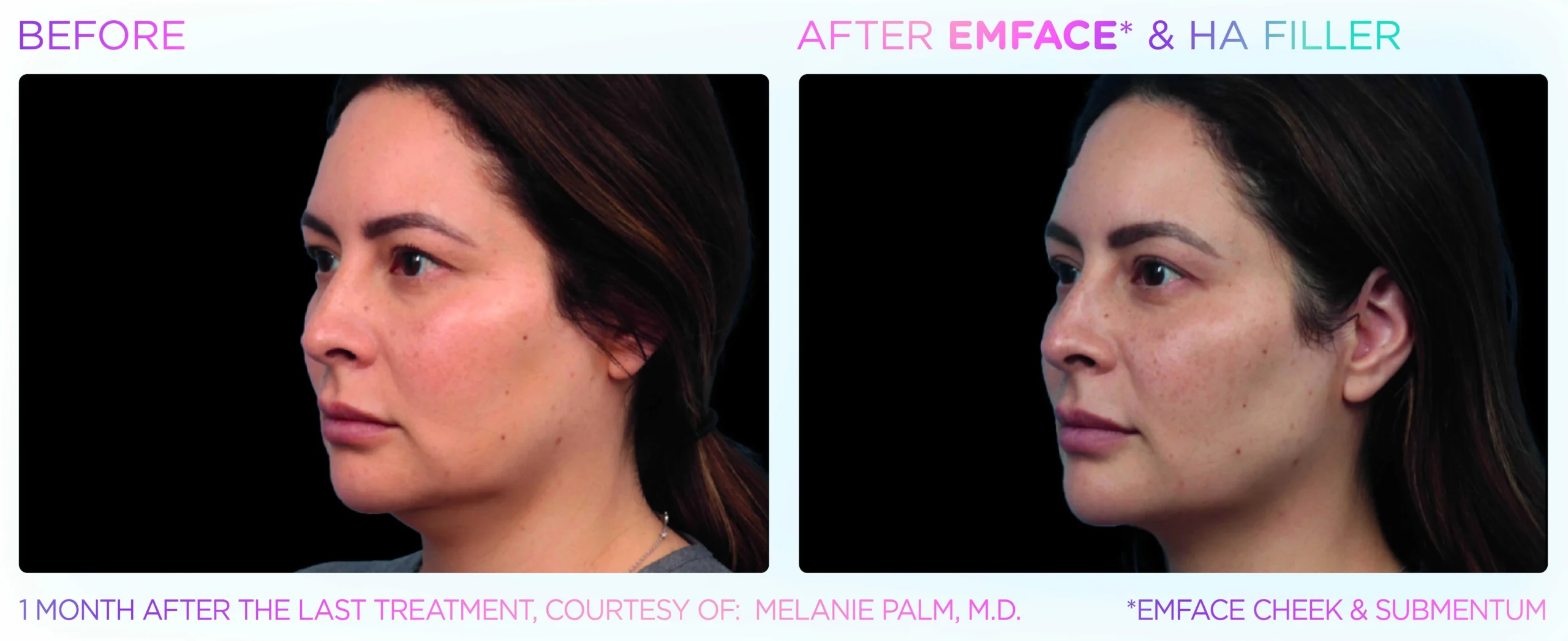 Emface Before & After 4