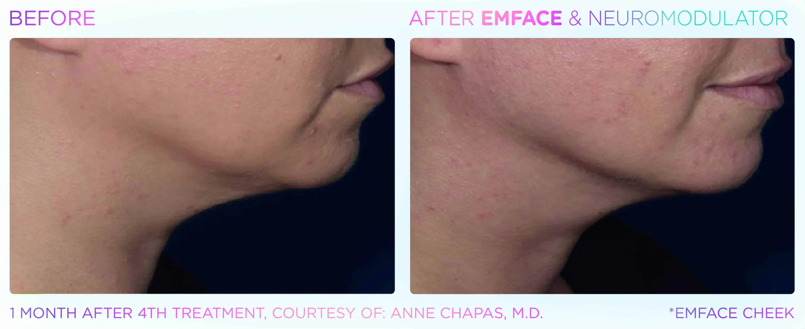 Emface Before & After 5