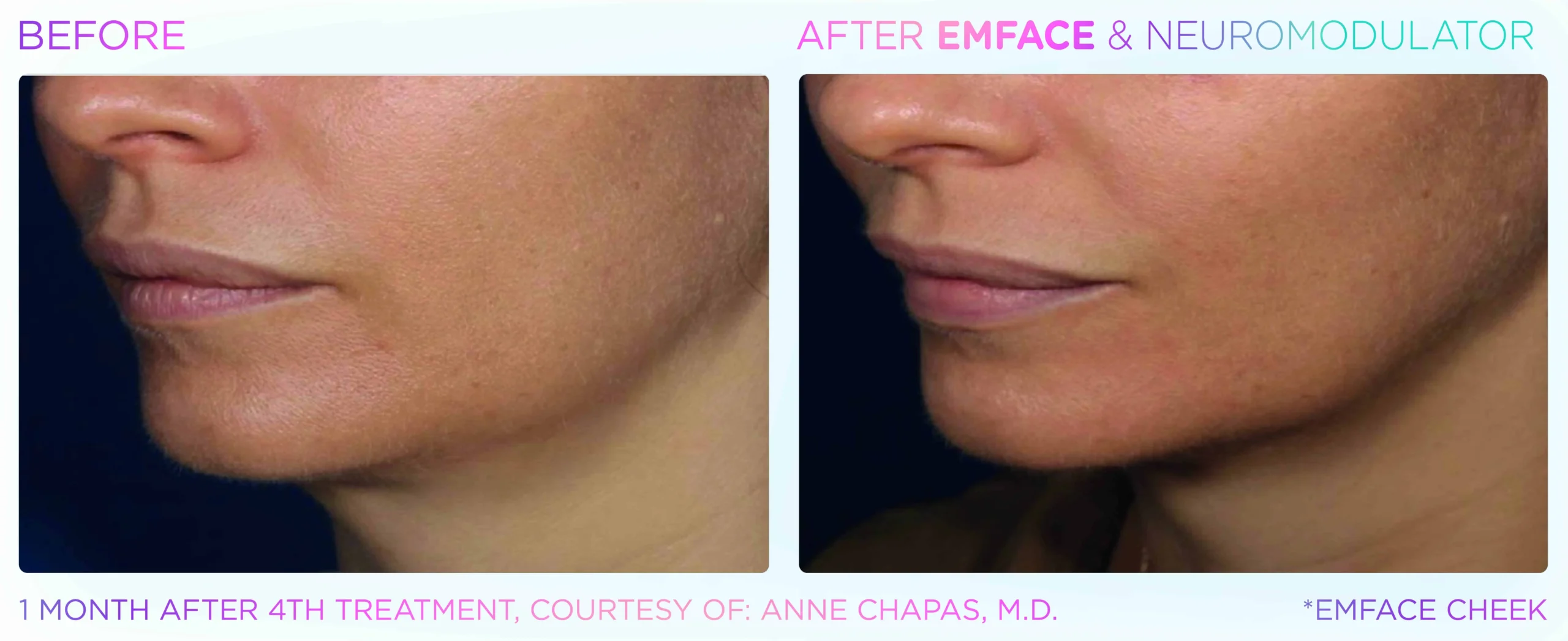 Emface Before & After 6