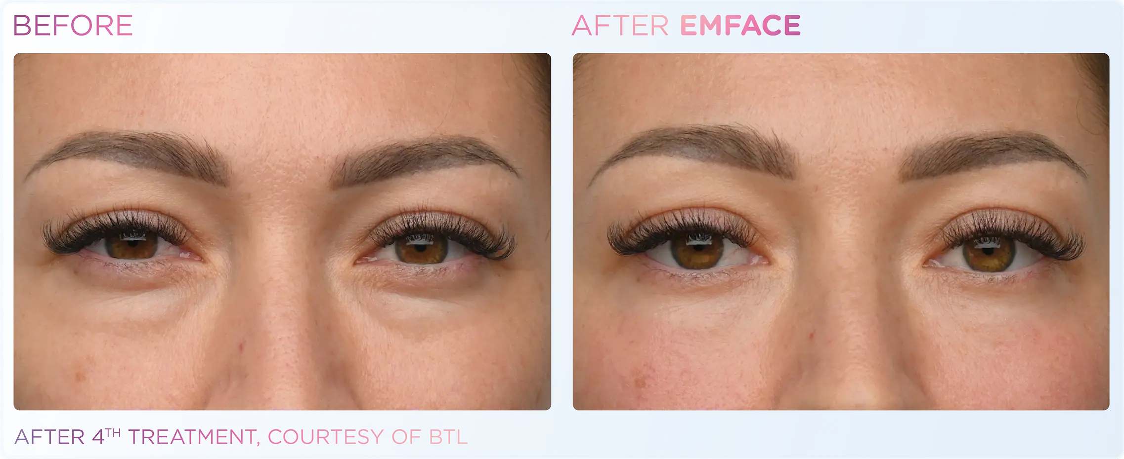 Emface Before & After 7