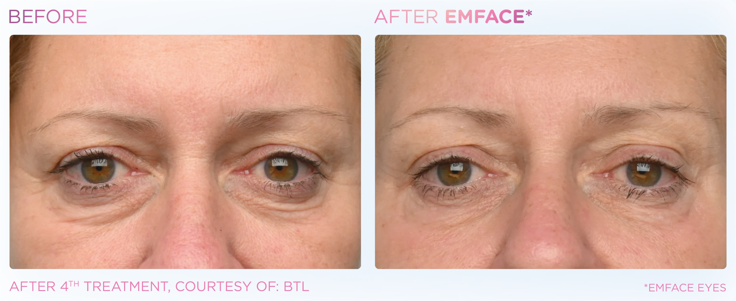 Emface Before & After 8