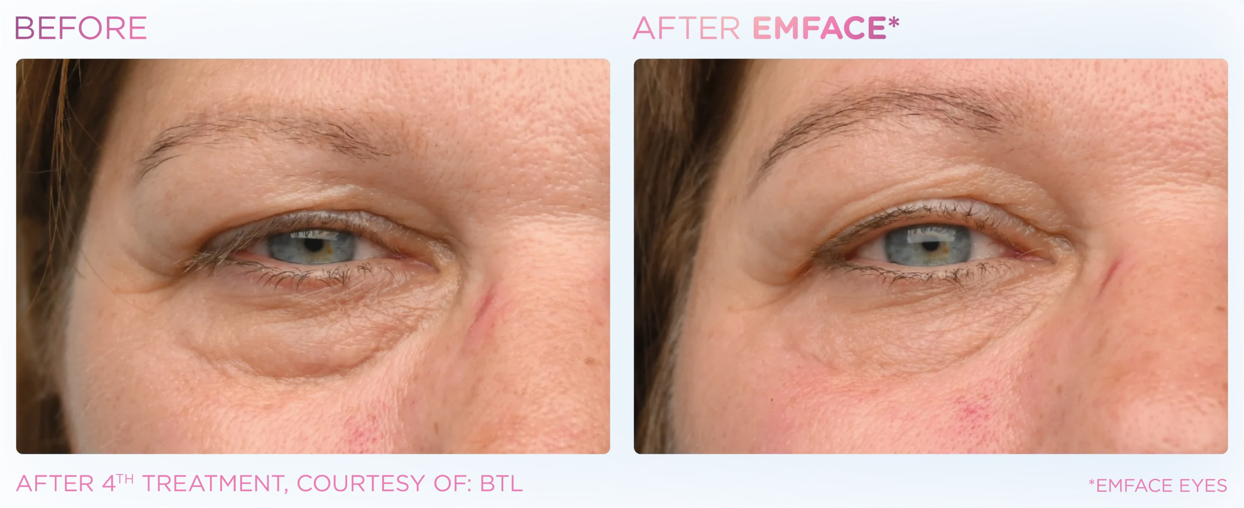 Emface Before & After 9