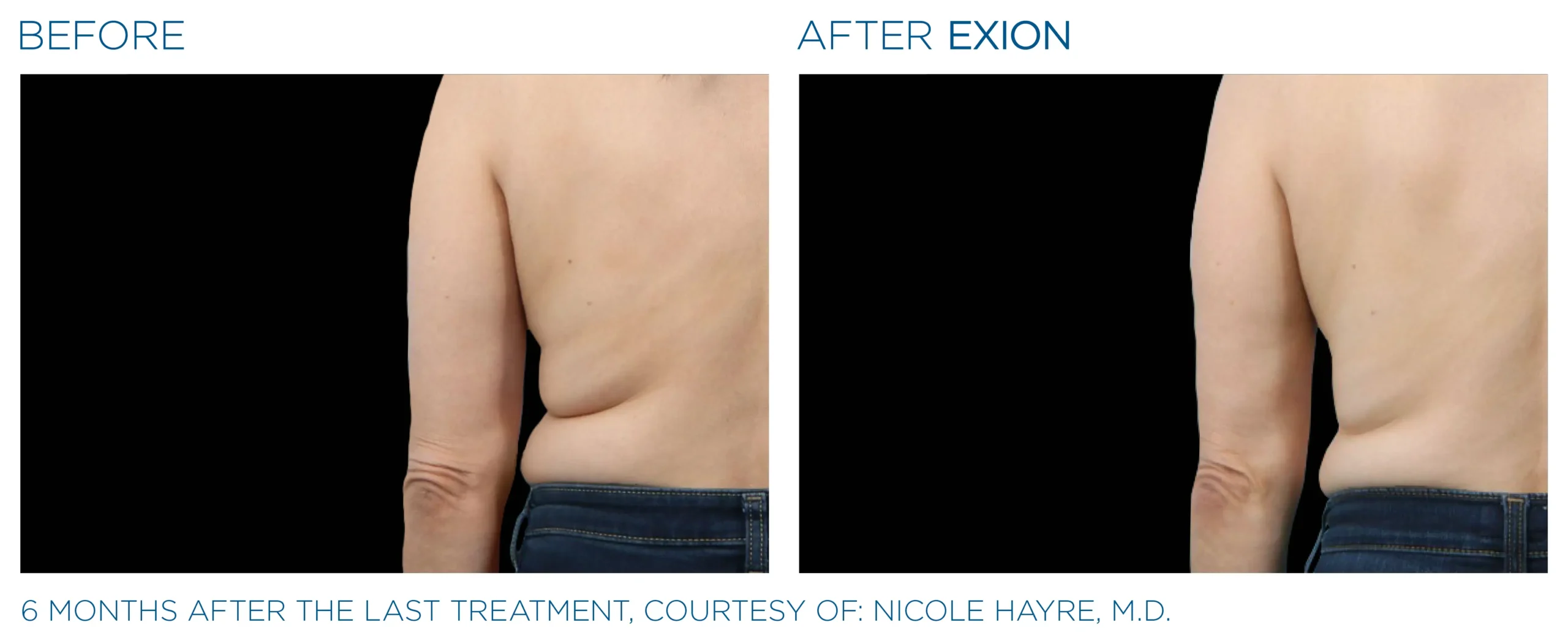 Exion Before & After 10